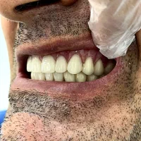 دندانسازی آوا قرارداد مستقیم کلیه بیمه ها|خدمات آرایشگری و زیبایی|خرم‌آباد, |دیوار