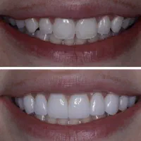 بمب تخفیف واقعی ۳۵٪ دندانپزشکی تا پایان سال