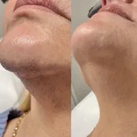 آخرین فرصت جشنواره لیزر موهای زائد