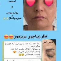 جوش لک و چین چروک امانت بریده|آرایشی، بهداشتی، درمانی|اهواز, آریاشهر|دیوار