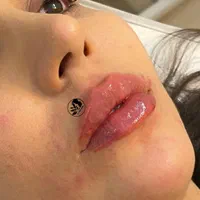 لیزر مو زائد/هایفو تراپی/ژل لب/تزریق چربی/بوتاکس|خدمات آرایشگری و زیبایی|اصفهان, جلفا|دیوار
