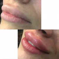 تزریق ژل|خدمات آرایشگری و زیبایی|رشت, حاجی آباد|دیوار