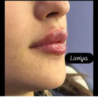 بوتاکس و ژل فیلر و پی آر پی برای خانم ها و آقایان|خدمات آرایشگری و زیبایی|بوشهر, |دیوار