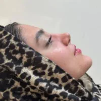 عمل بینی اقساطی فقط با ماهی ۳ تومن استخوانی وگوشتی