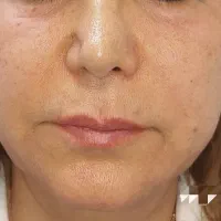 جوانسازی قوی بدون مواد