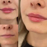 تزریق ژل وبوتاکس