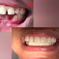 ساخت دندان مصنوعی اقتصادی وبا کیفیت|خدمات آرایشگری و زیبایی|ری, دیلمان|دیوار