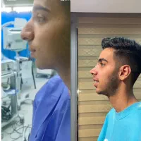 عمل بینی فقط با 30 ملیون|خدمات آرایشگری و زیبایی|شیراز, قصرالدشت|دیوار