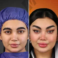 بلفاروپلاستی فیلر هایفو ساکش غبغب بوتاکس و ژل