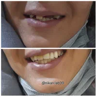 دندانسازی دندان مصنوعی تحویل ۲روزه باضمانت|خدمات آرایشگری و زیبایی|اصفهان, کشاورزی|دیوار