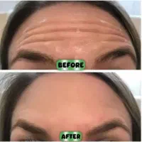 تزریق انواع خدمات صورت