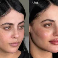 جوانسازی و حجم دهی صورت با کمترین هزینه|خدمات آرایشگری و زیبایی|مشهد, هفت تیر (حافظ)|دیوار