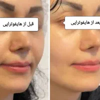 جوانسازی و لیفت پوست بدون جراحی با قویترین هایفو|خدمات آرایشگری و زیبایی|کرج, فاز ۲ مهرشهر|دیوار