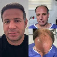 کاشت مو/کاشت ریش/کاشت ابرو اقساط*ی در اصفهان|خدمات آرایشگری و زیبایی|فولادشهر, فولادشهر|دیوار