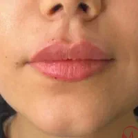 انجام خدمات ژل بوتاکس صورت