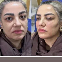 مدل برای درمان افتادگی های صورت و ژل لب و بوتاکس|خدمات آرایشگری و زیبایی|تهران, میرداماد|دیوار