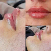 ژل ،بوتاکس لیزر مو رفع تتو پاکسازی هایفو توسط پزشک|خدمات آرایشگری و زیبایی|پرند, فاز ۲|دیوار