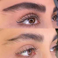 میکروبلیدینگ فیبروز