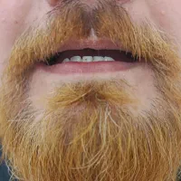 پروتز متحرک دندان|آرایشی، بهداشتی، درمانی|گنبد کاووس, |دیوار