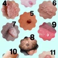 درمان زگیل و تبخال تناسلی