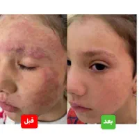 درمان قطعی پیسی و پسوریازیس