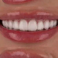 لمینیت emax با تخفیف 50%