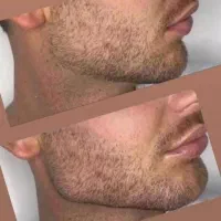 جشنواره ژل بوتاکس فیلر لیزرجوانسازمزو|خدمات آرایشگری و زیبایی|تبریز, |دیوار