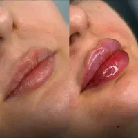 تخفیف ویژه بوتاکس و فیلر لب