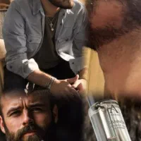 درمان ریزش سکه ای (آلوپسی)بامتدترین روش درمان