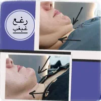 کوچک کردن بینی.رفع افتادگی‌پلک و چروک صورت|خدمات آرایشگری و زیبایی|زاهدان, |دیوار