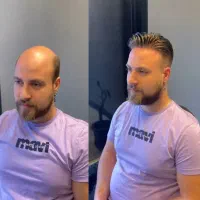 پروتز مو سنندج