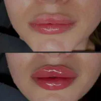 ژل لب.بوتاکس|خدمات آرایشگری و زیبایی|شیراز, شهرک فرزانگان|دیوار