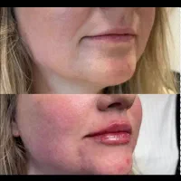 تخفیفات  ژل  بوتاکس مزو میکرو پی آرپی