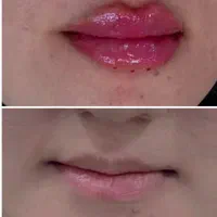 تزریق ژل وبوتاکس هایفو|خدمات آرایشگری و زیبایی|مشهد, کوی سیدی|دیوار