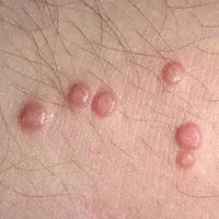 زگیل تناسلی.لیزر زگیل.کرایوتراپی فریز.درمان پوست|خدمات آرایشگری و زیبایی|اهواز, کیانپارس |دیوار