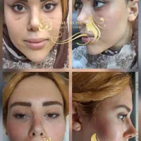 اندولیفت لیفت شقیقه گونه ابروچشم مینی بلفاروپلاستی