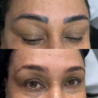 لیزر حذف تتو باپترو و ازاد