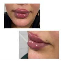 اف ویژه زیبایی تزریق ژل، بوتاکس، پی ار پی