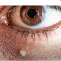 درمان کیست ملیا زیر چشم و برداشتن خال و زگیل|خدمات آرایشگری و زیبایی|نیشابور, دارایی|دیوار