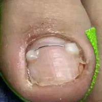 درمان و اصلاح ناخن پا در کلینیک لوتس و منزل|خدمات آرایشگری و زیبایی|تهران, یوسف‌آباد|دیوار