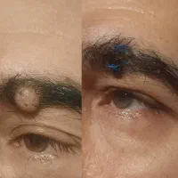 برداشتن خال،تزریق ژل و بوتاکس فیشیال تخفیف ویژه