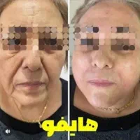 جشنواره لیفت/جوانسازی/انواع هایفو/در1جلسه فقط ۸۹۰ت|خدمات آرایشگری و زیبایی|اصفهان, ناژوان|دیوار