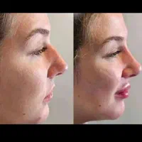 طراحی لیفت بینی وفرمدهی عملی(بدون جراحی)پزشک متخصص|خدمات آرایشگری و زیبایی|مشهد, سناباد|دیوار