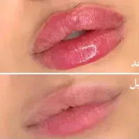 ژل و بوتاکس فیلر مزو ژل مزو تخفیف ویژه فول فیس|خدمات آرایشگری و زیبایی|مشهد, ملک‌آباد|دیوار