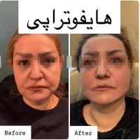 هایفو  ۳۶ بعدی نتیجه آنی فقط  ۱ ملیون