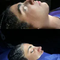 جراحی زیبایی بینی و پلک با تعرفه دولتی