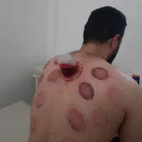 حجامت عام و با کشی.