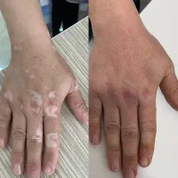 بدون برگشت و دائمی درمان بیماری پوستی|خدمات آرایشگری و زیبایی|گنبد کاووس, |دیوار