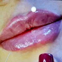 جشنواره بوتاکس و فیلر ولیزر در کلینیک زیبایی