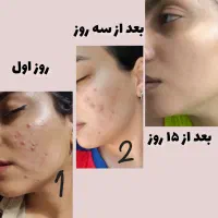 سرم ضد جوش قوی
